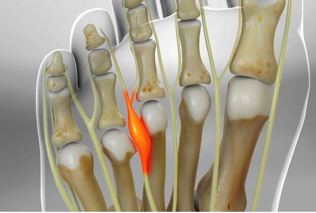 Ilustração de neuroma de Morton entre os dedos do pé